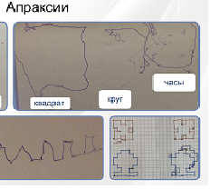 Апраксия примеры