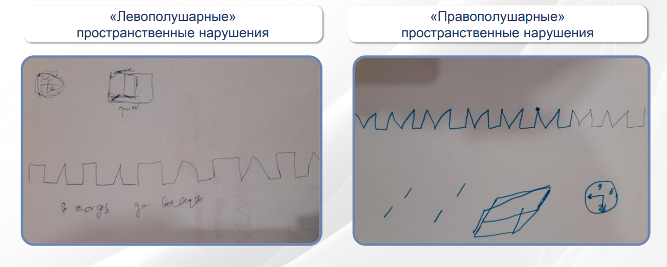 Пространственная апраксия примеры